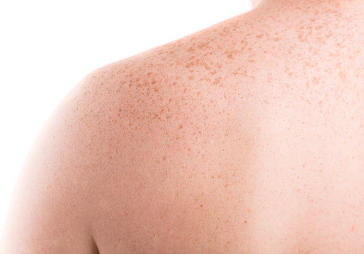 Pico Laser Αφαίρεση Πανάδων