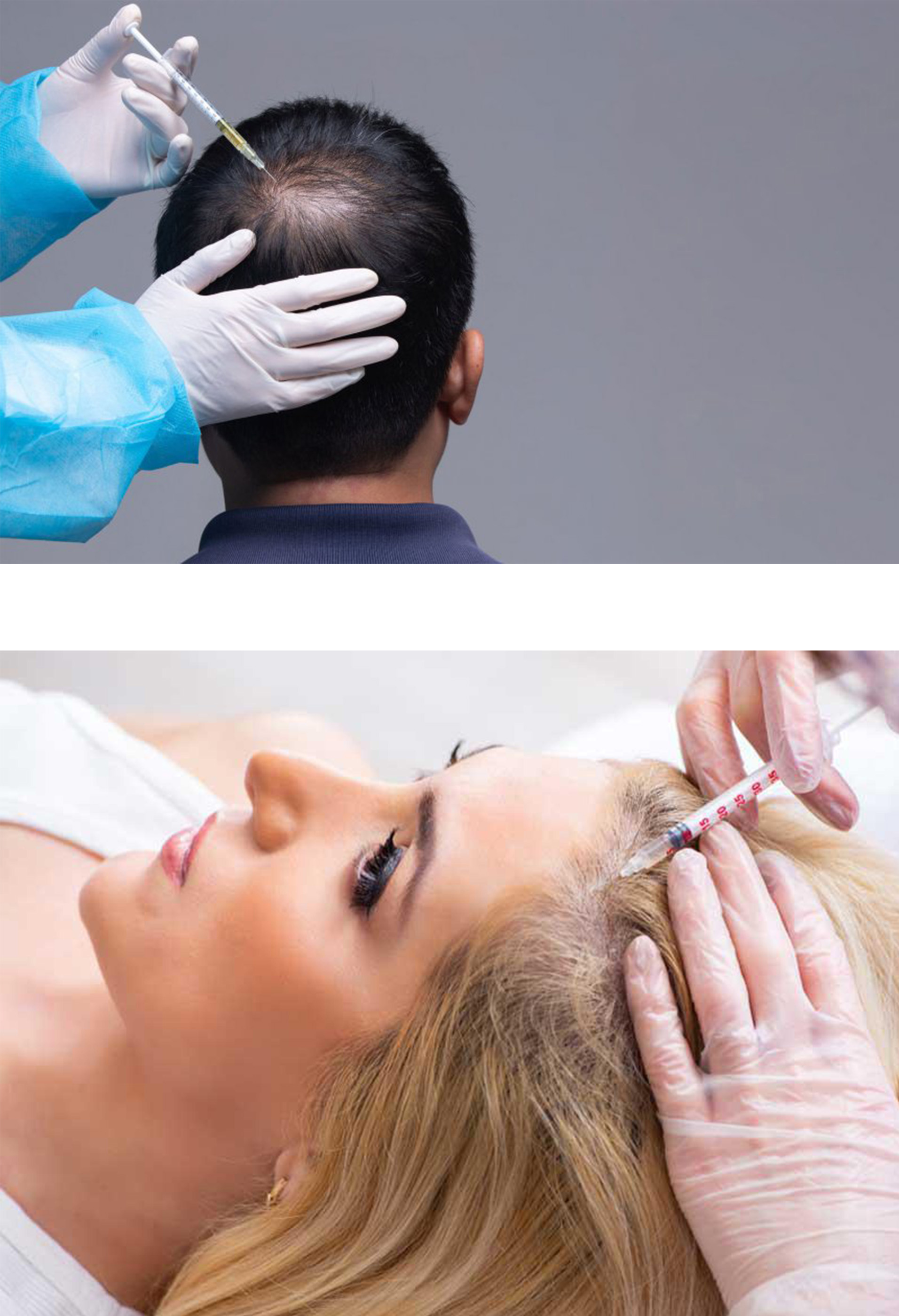 Μεσοθεραπεία Μαλλιών