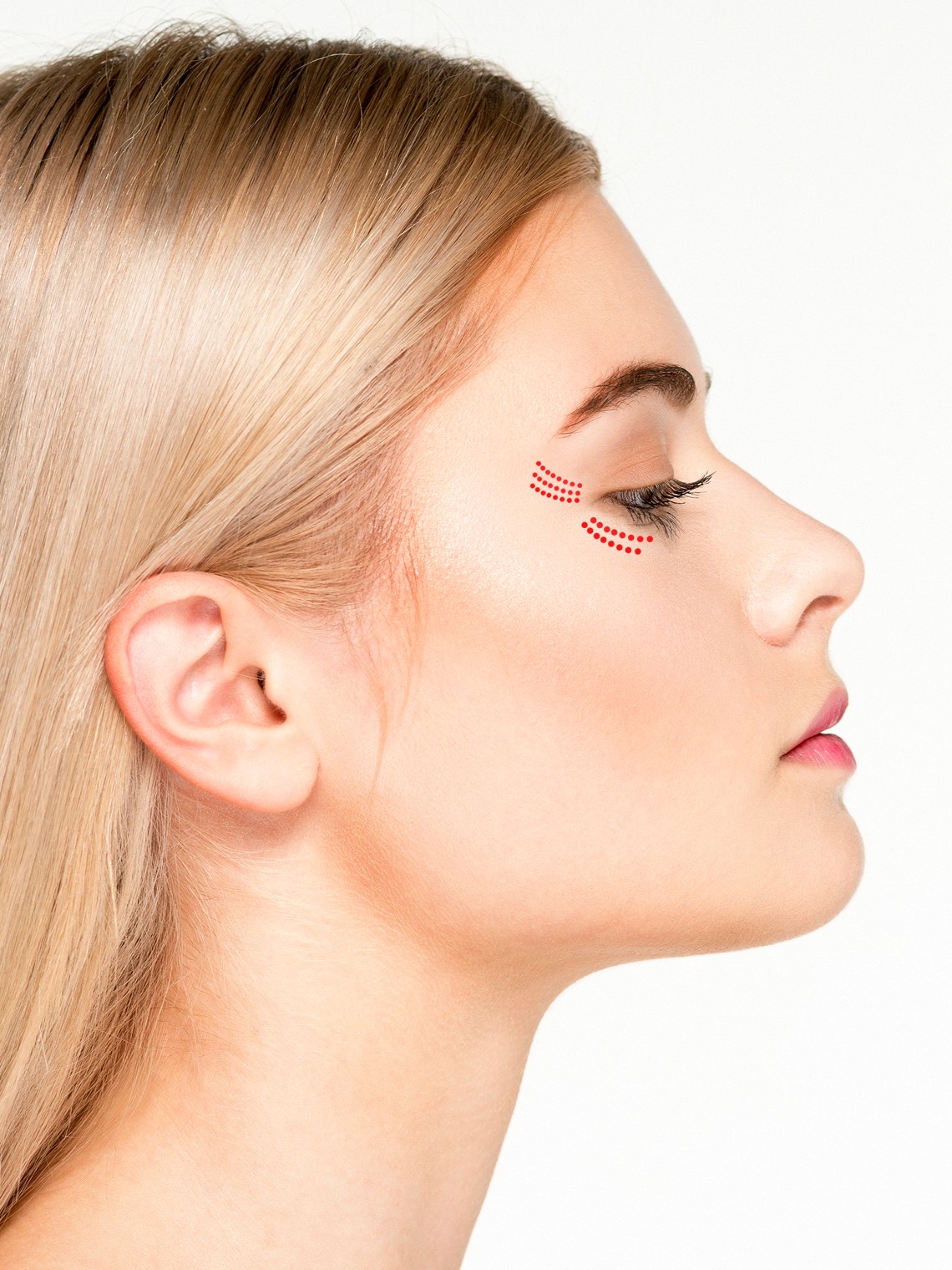 Βλεφαροπλαστική ανέμακτη Τρίκαλα