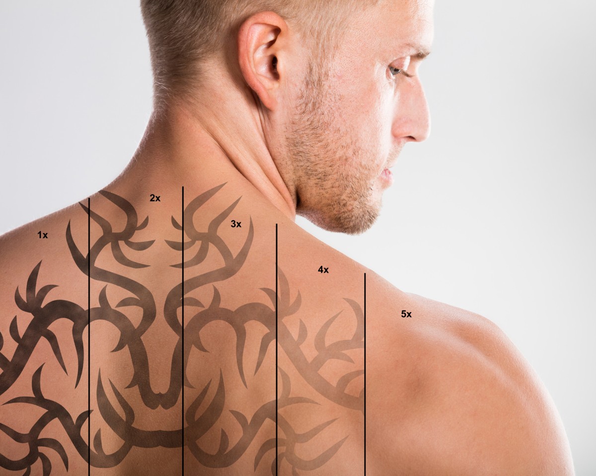 Αφαίρεση Τατουάζ Πανάδων Τρίκαλα