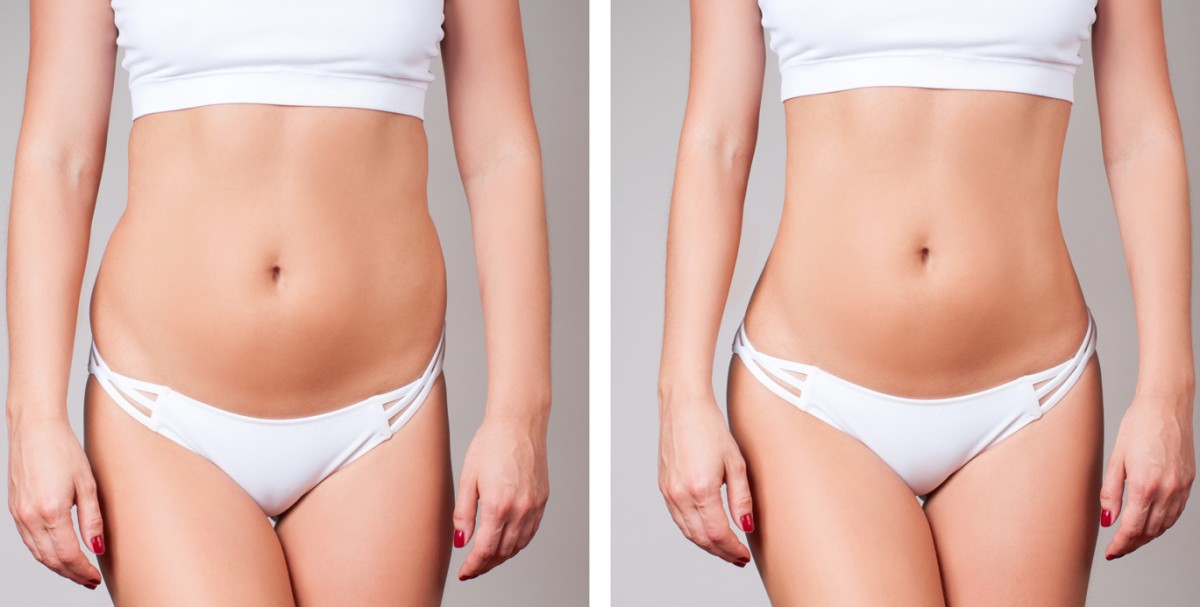 Cryolipolysis Body